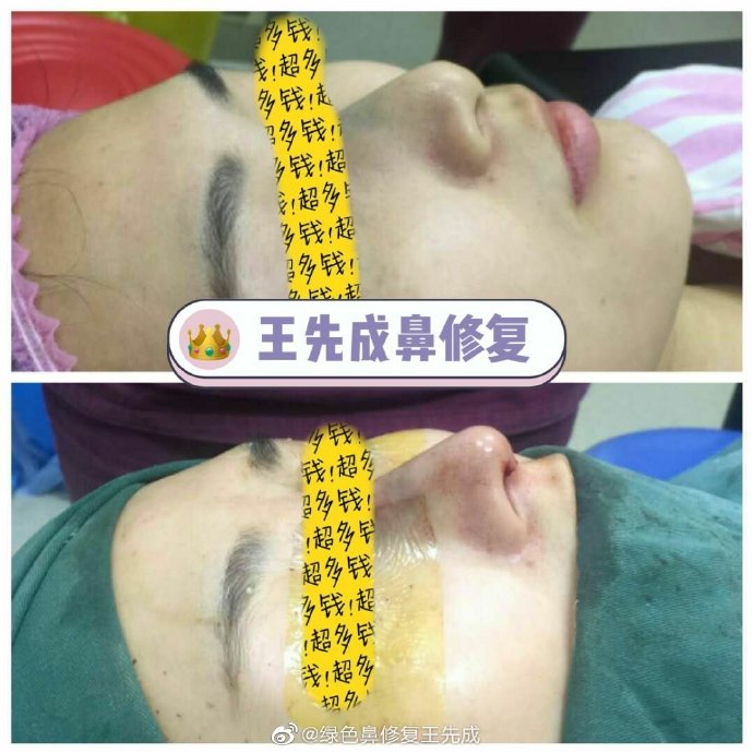 长沙鼻修复哪个医生好？