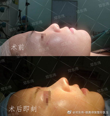 邓东伟和吴开泉哪个做的鼻子好