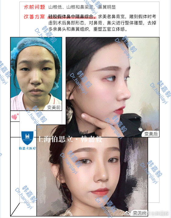 上海百达丽韩嘉毅做鼻修复好不好？鼻修复案例有吗？
