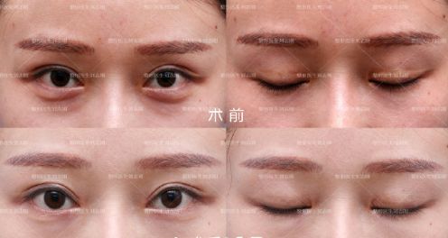 大连刘志刚修复双眼皮怎么样