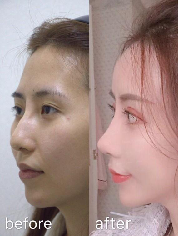 李林医生做鼻子怎么样