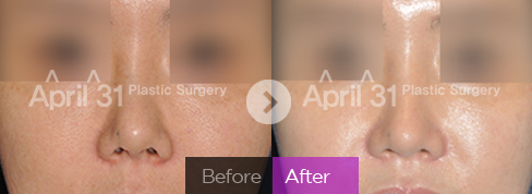 金载勋鼻修复技术怎么样？价格贵不贵？