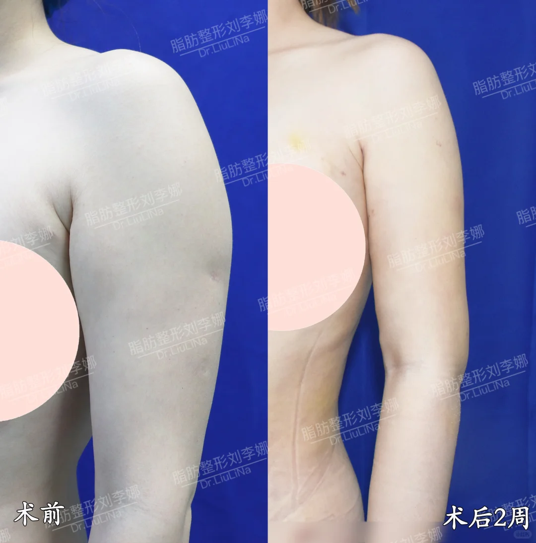 上海刘李娜吸脂技术怎么样？刘李娜体雕脂肪效果好不好？