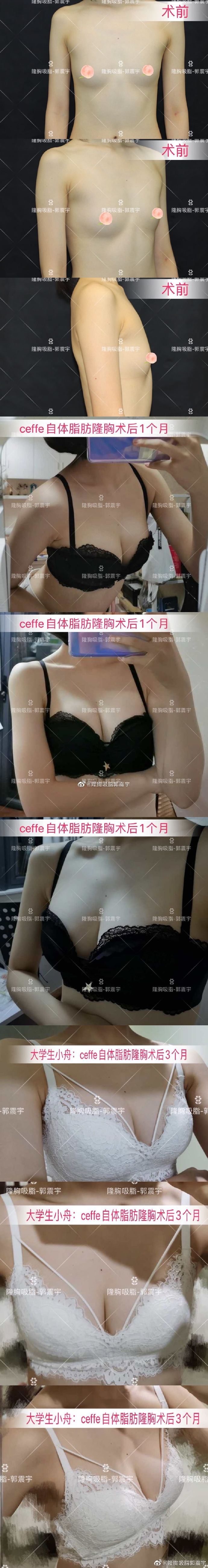 广州郭震宇隆胸技术怎么样