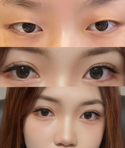 成都双眼皮做得最好的是哪个医生？傅荣、练才华、卢尚兵、高亮、杨迪、江涛、秦小惠、李焰、徐敦、王立鹏？