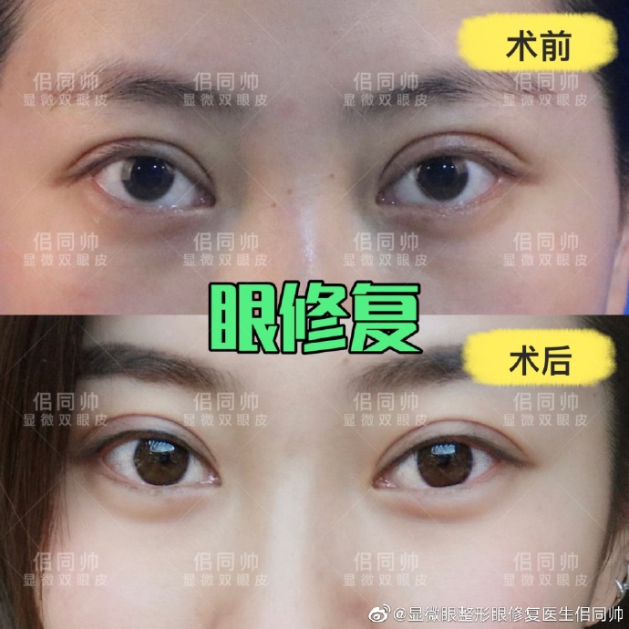 上海哪个医生双眼皮修复技术好