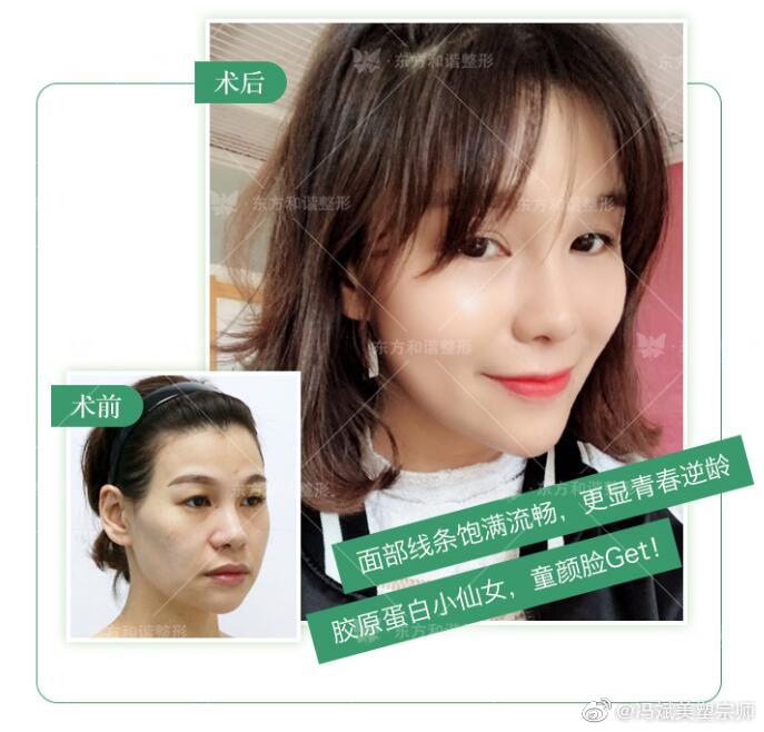 北京脂肪填充名医都有哪些呢？