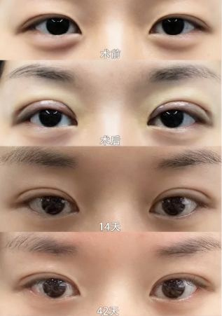 成都邵建川和林靖哪个医生做眼修复技术好？邵建川和林靖双眼皮修复预约电话