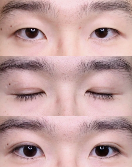 成都练才华和傅荣割双眼皮哪个好？练才华和傅荣双眼皮技术谁更好？练才华和傅荣预约电话