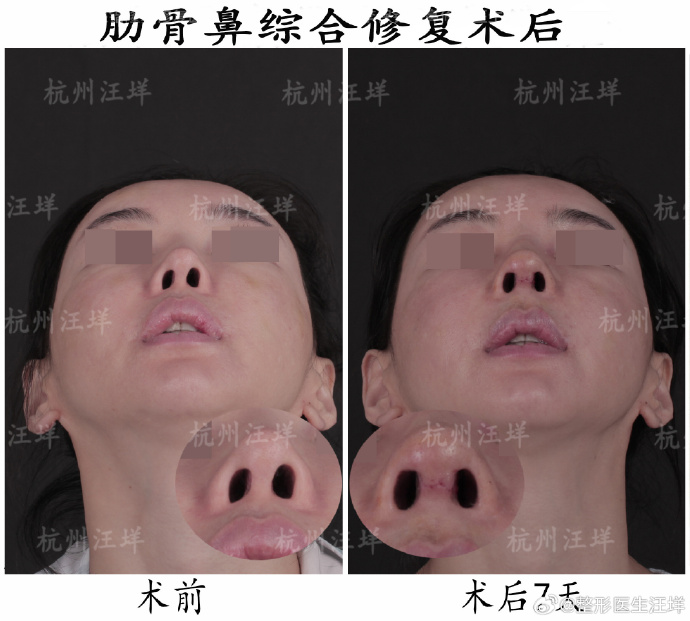 杭州隆鼻修复专家汪垟和李保锴哪个医生做鼻修复更好？