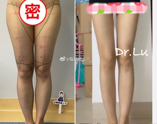 卢新蕾吸脂有后遗症吗？卢新蕾吸脂会凹凸不平吗？