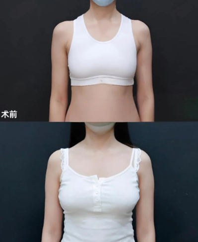 章小平和周璐珩丰胸技术哪个好？重庆隆胸专家还有推荐的吗？