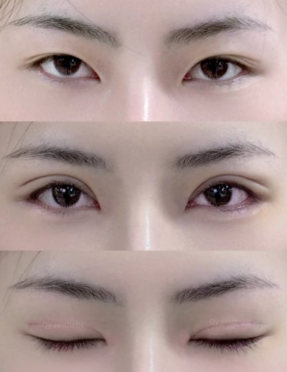 武汉李名富和徐逸哪个医生割双眼皮技术更好？李名富和徐逸怎么预约？