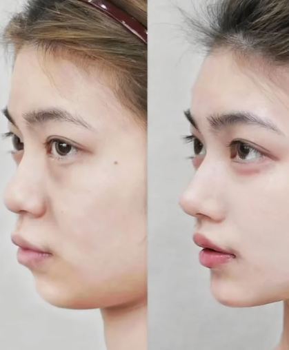 贵阳隆鼻专家杜良军和陈祥军哪个医生做鼻子好？