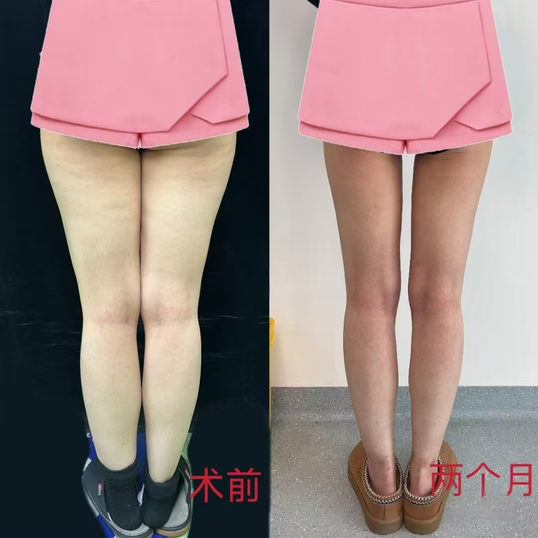 北京八大处吸脂技术最好的医生是哪个？吕倩雯、杨增杰、陈博、王维新、李发成、顾云鹏谁吸脂好？