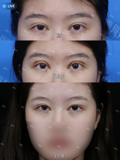 重庆双眼皮修复专家曹阳、刘杰、田怡这三个医生哪个最好？