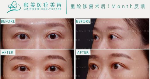 双眼皮修复上海朴相根和北京刘风卓哪个好