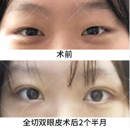 割双眼皮八大处于晓波和王太玲哪个好？