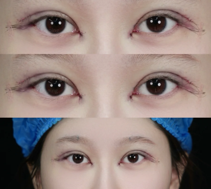 上海马娟和刘平哪个医生做双眼皮修复技术好？马娟和刘平谁眼修复技术好？