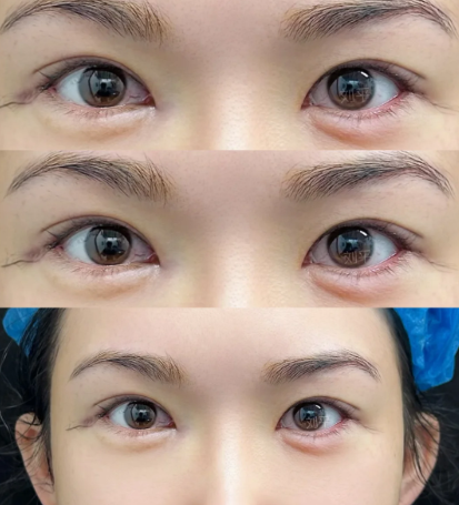 上海双眼皮修复专家刘平和马娟医生哪个做眼修复技术好？