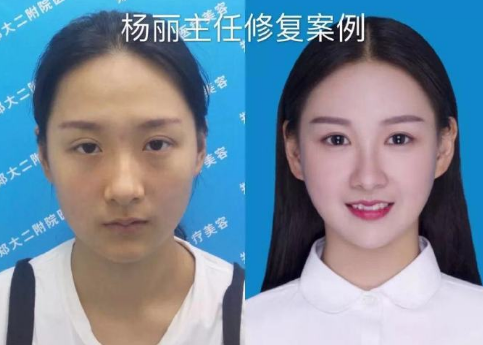 郑州杨丽和田国静哪个修复双眼皮最好