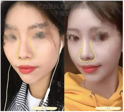 南宁隆鼻于海生和刘泳铖哪个医生技术好？于海生和刘泳铖做鼻子谁口碑好？