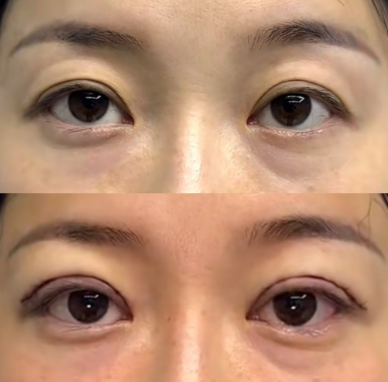 上海双眼皮修复最牛的医生是哪个？马娟、郑小红、张楚、曾翾、杜园园眼修复谁好？