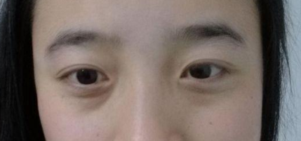 北京八大处哪个医生去眼袋好