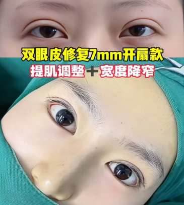 上海双眼皮修复医生哪个技术靠谱？张楚、张园园、郑小红、杜园园、滕彦、沈莺莺？
