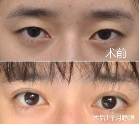 武汉哪个医生做双眼皮修复好