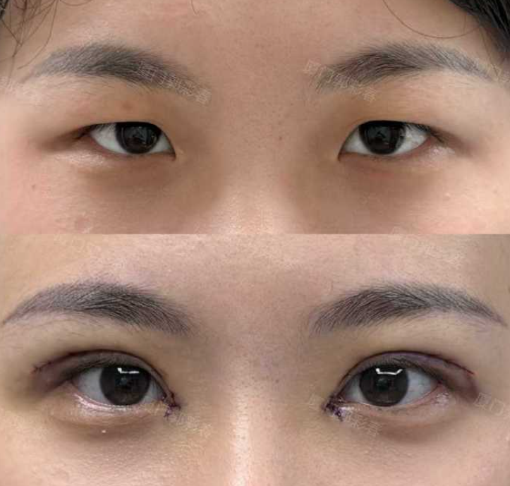 厦门双眼皮专家郭彩春和张帆哪个医生做的好？郭彩春和张帆双眼皮预约咨询电话
