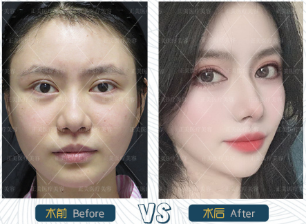最著名双眼皮修复专家是哪个