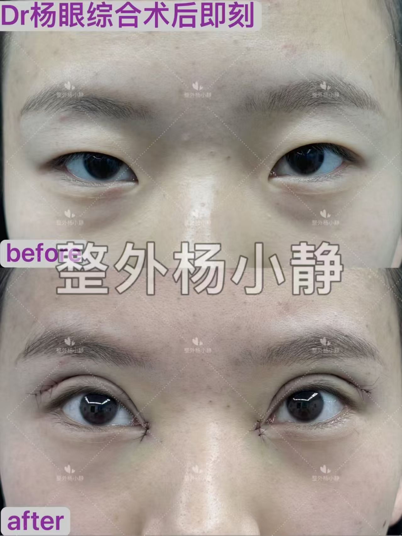 太原割双眼皮医生杨小静和张慧华做双眼皮咋样？杨小静和张慧华割双眼皮预约