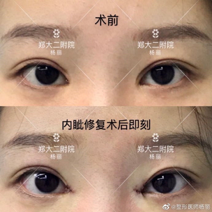 杨丽修复双眼皮怎么样