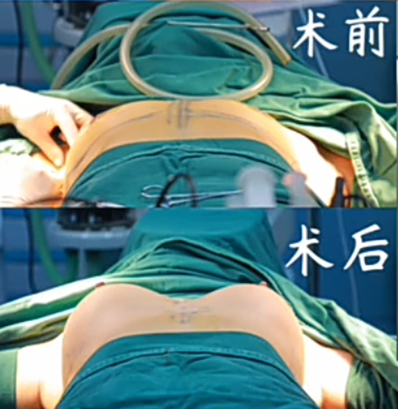 南京假体隆胸夏建军和沈干哪个医生口碑好？夏建军沈干隆胸咨询预约电话