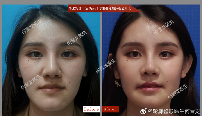 上海时光何晋龙做磨骨内推下颌角效果好不好？