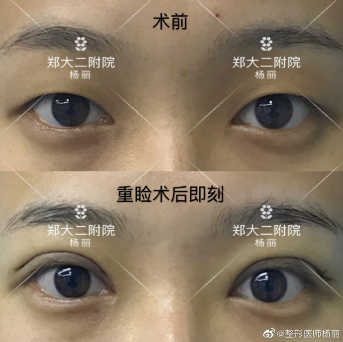 杨丽和田国静谁做的双眼皮好