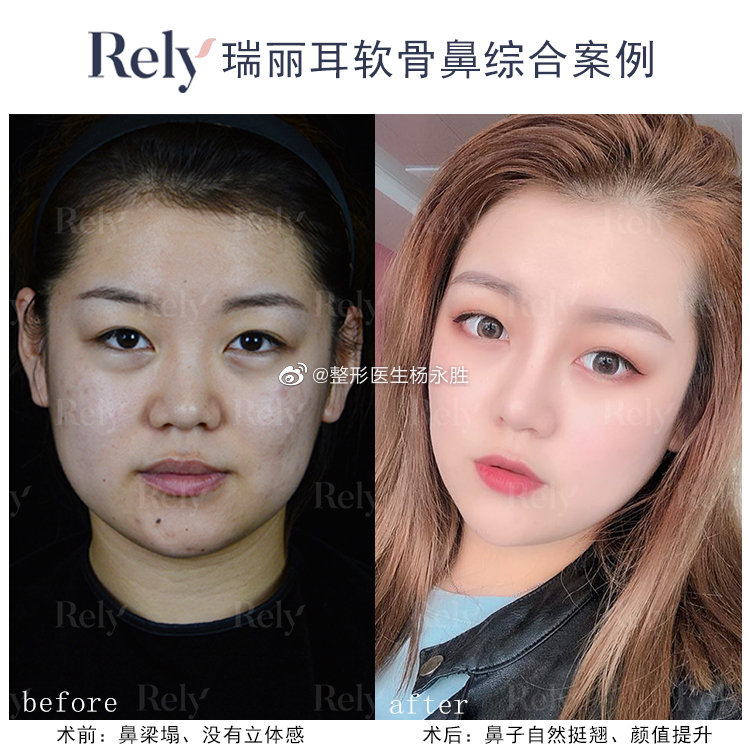 哈尔滨杨永胜和黄志祥哪个医生隆鼻技术好？杨永胜和黄志祥隆鼻咨询预约
