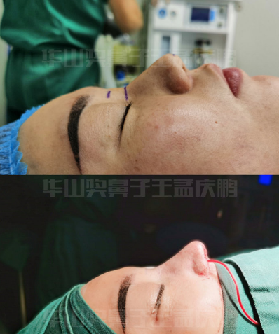 郑州孟庆鹏隆鼻怎么样