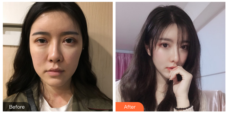 郑州做隆鼻哪位医生好