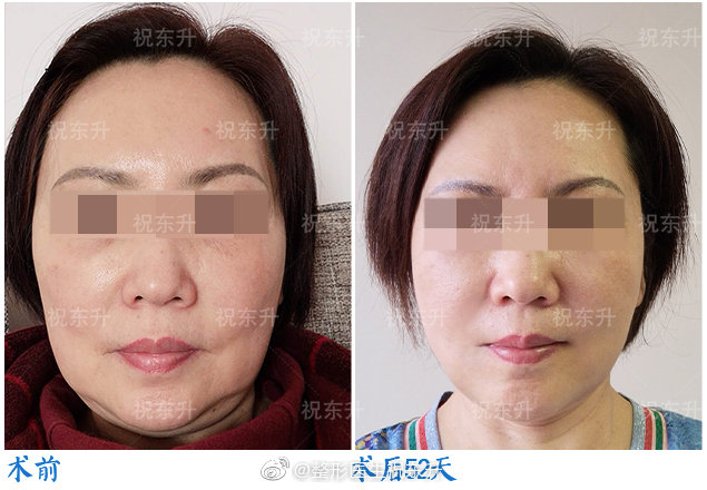 祝东升和李晓东面部提升谁做的好
